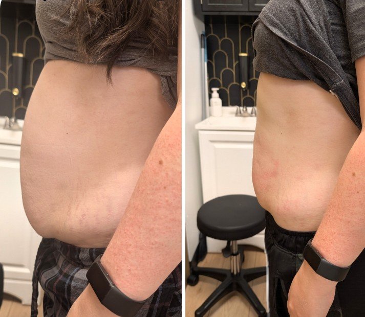 Before and after photos of a client's midsection, side by side: before treatment on the left, after 4 T-Shape 2 treatments on the right