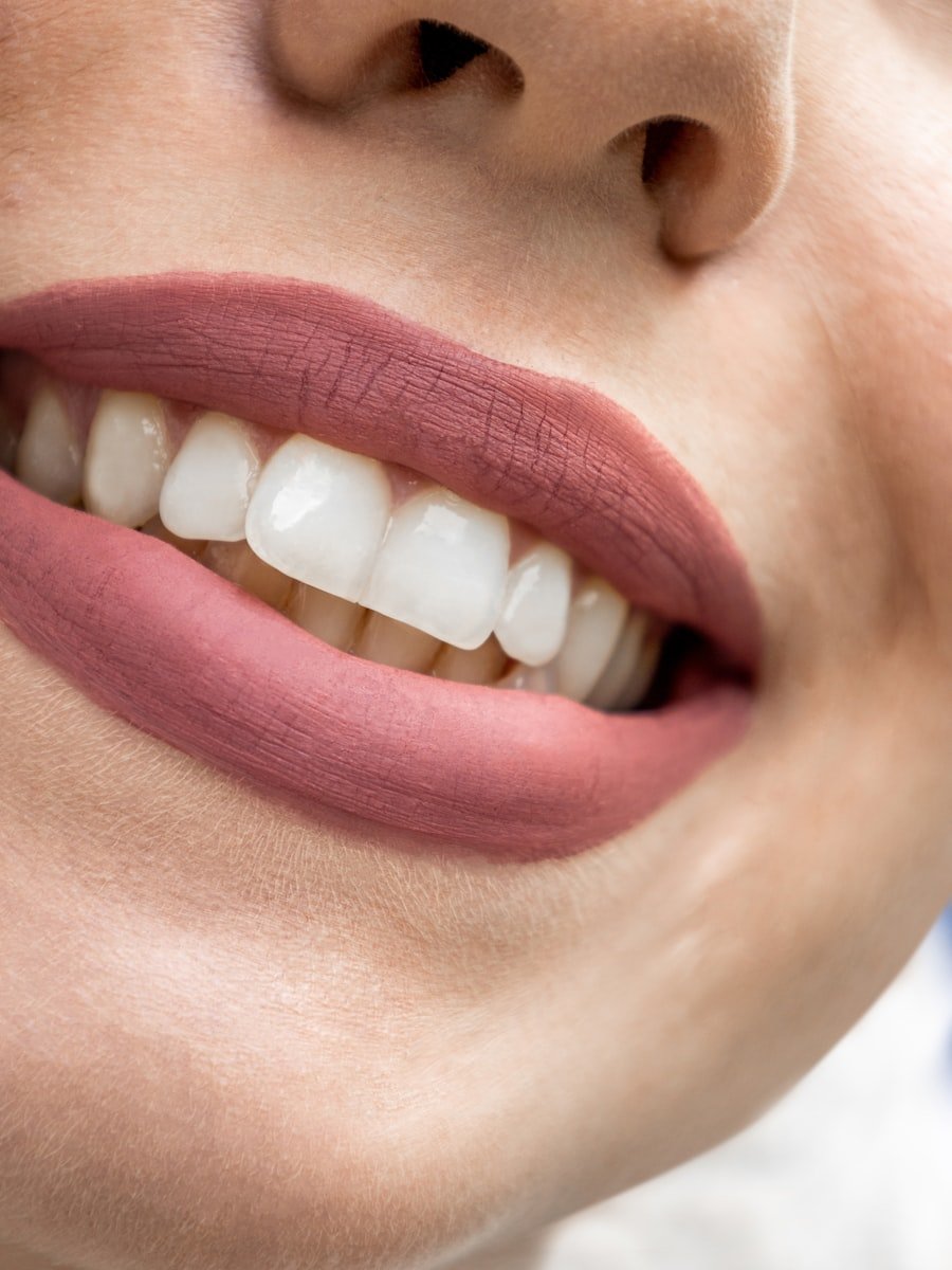 Teeth Whitening